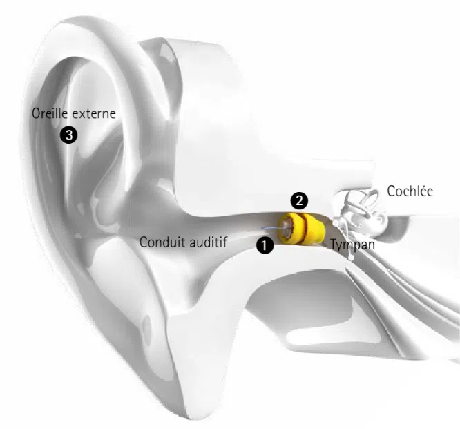 Lyric oreille phonak